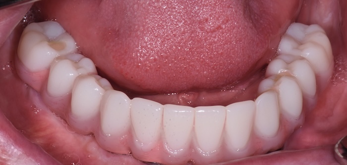 Lower hybridge after