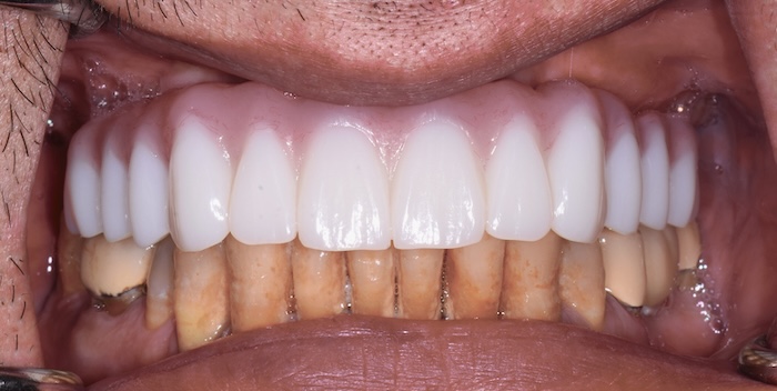 Upper hybridge before