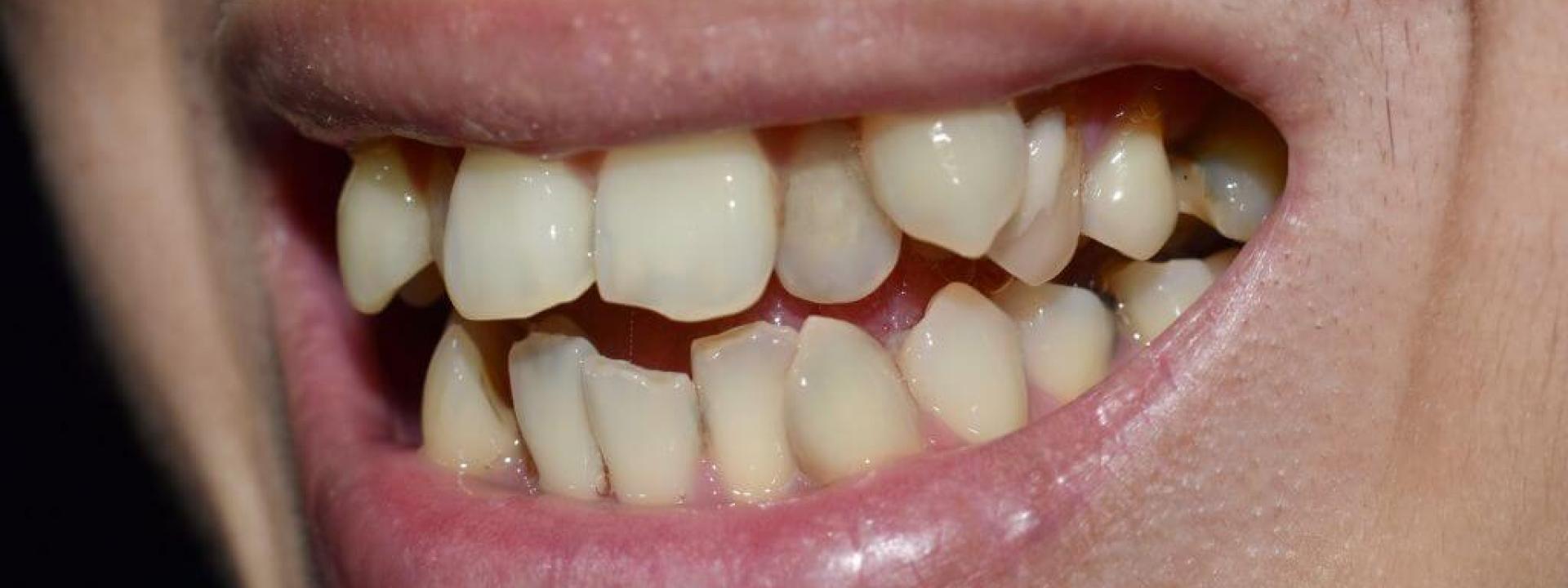 Hyperdontia in human dental services.